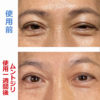 A.K様の眼瞼下垂の目の変化