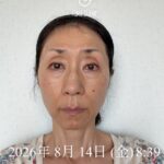 【TO様モニター体験記２】20日目の変化、毛穴・肝斑・シミ・肌全体が滑らかに