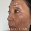美容液ムントジリモニターTO様体験記④40日目：写メが前より若く写っている